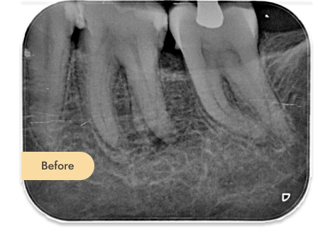 Root canal Treatment 
