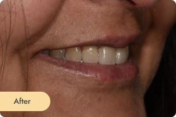 teeth whitening After Cleaning