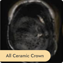 ceramic crown