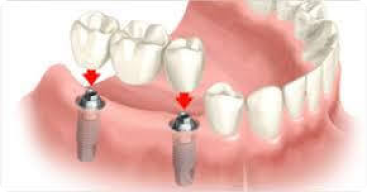 best doctor for dental implants