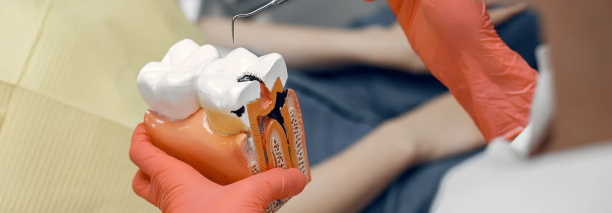 best doctor for root canal treatment | root canal treatment