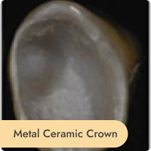METAL  CERAMIC CROWN 