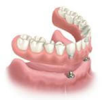 removable  dentures