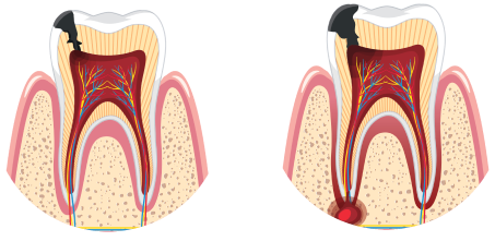 root canal Treatment 