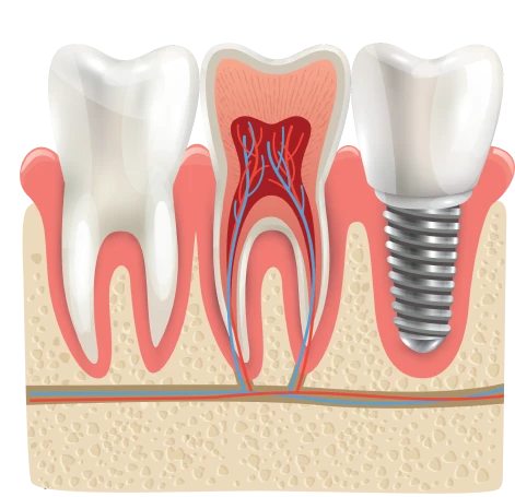 teeth gum bleeding treatment | gum disease treatment