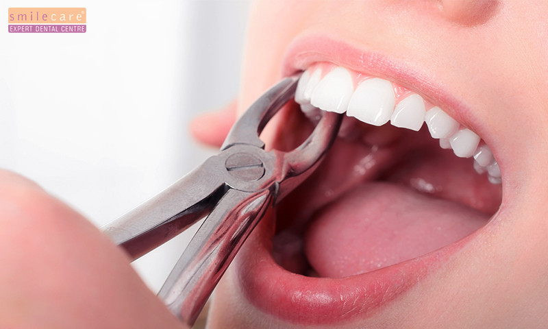 tooth extraction procedure | tooth removal surgery | surgical tooth extraction