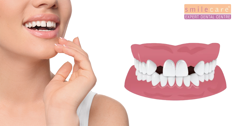 teeth gap solution | how to fill gap between teeth