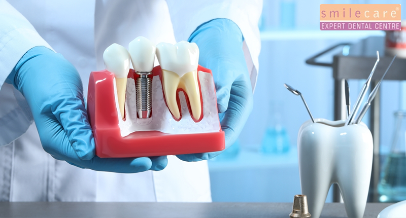 Discover the cutting-edge advancements in dental implant technology for a brighter smile. Explore the latest innovations today