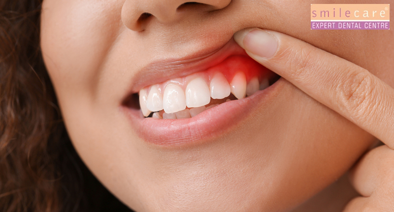 "Early signs such as swollen gums and bleeding while brushing progress to more severe symptoms like receding gums and tooth loss, emphasizing the need for timely intervention and proper oral hygiene habits