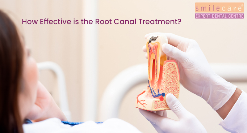 root canal treatment for broken teeth