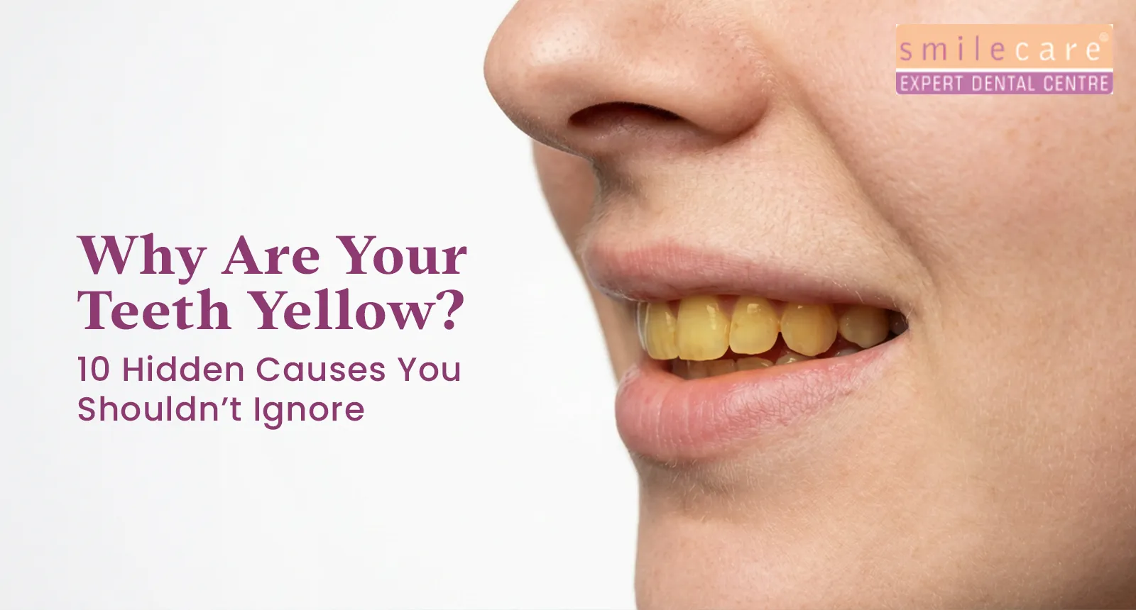 why-are-your-teeth-yellow