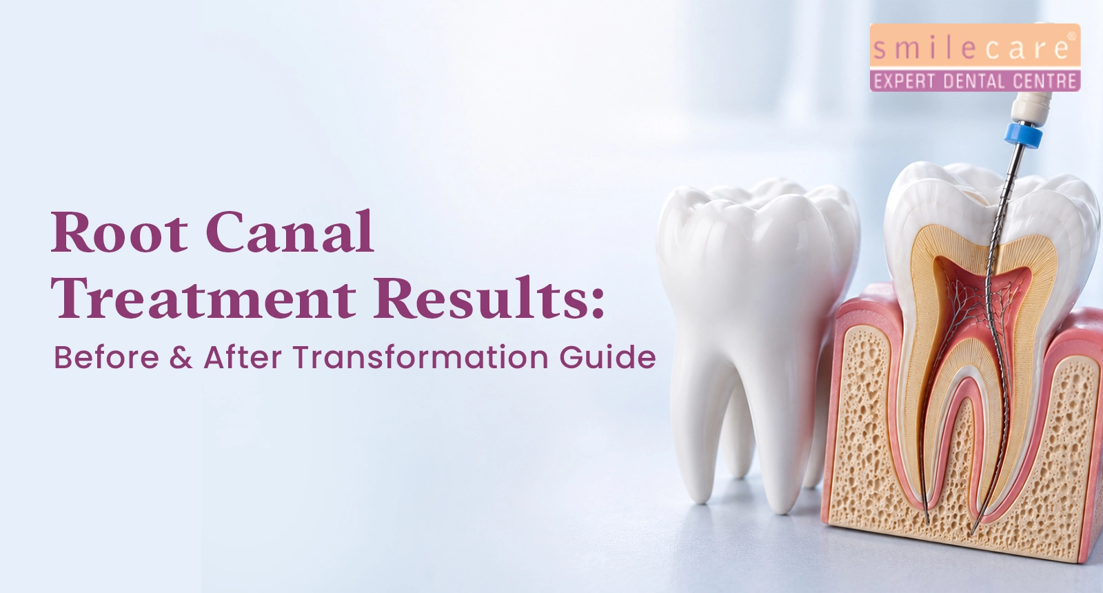 root canal treatment results