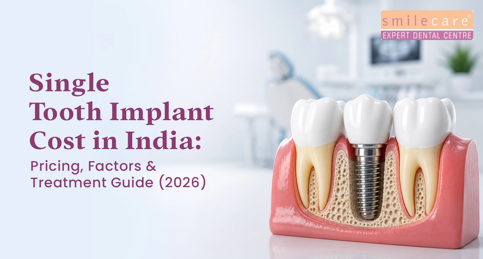 single tooth implant